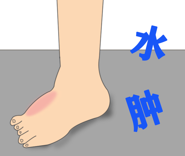 如何预防脚部水肿